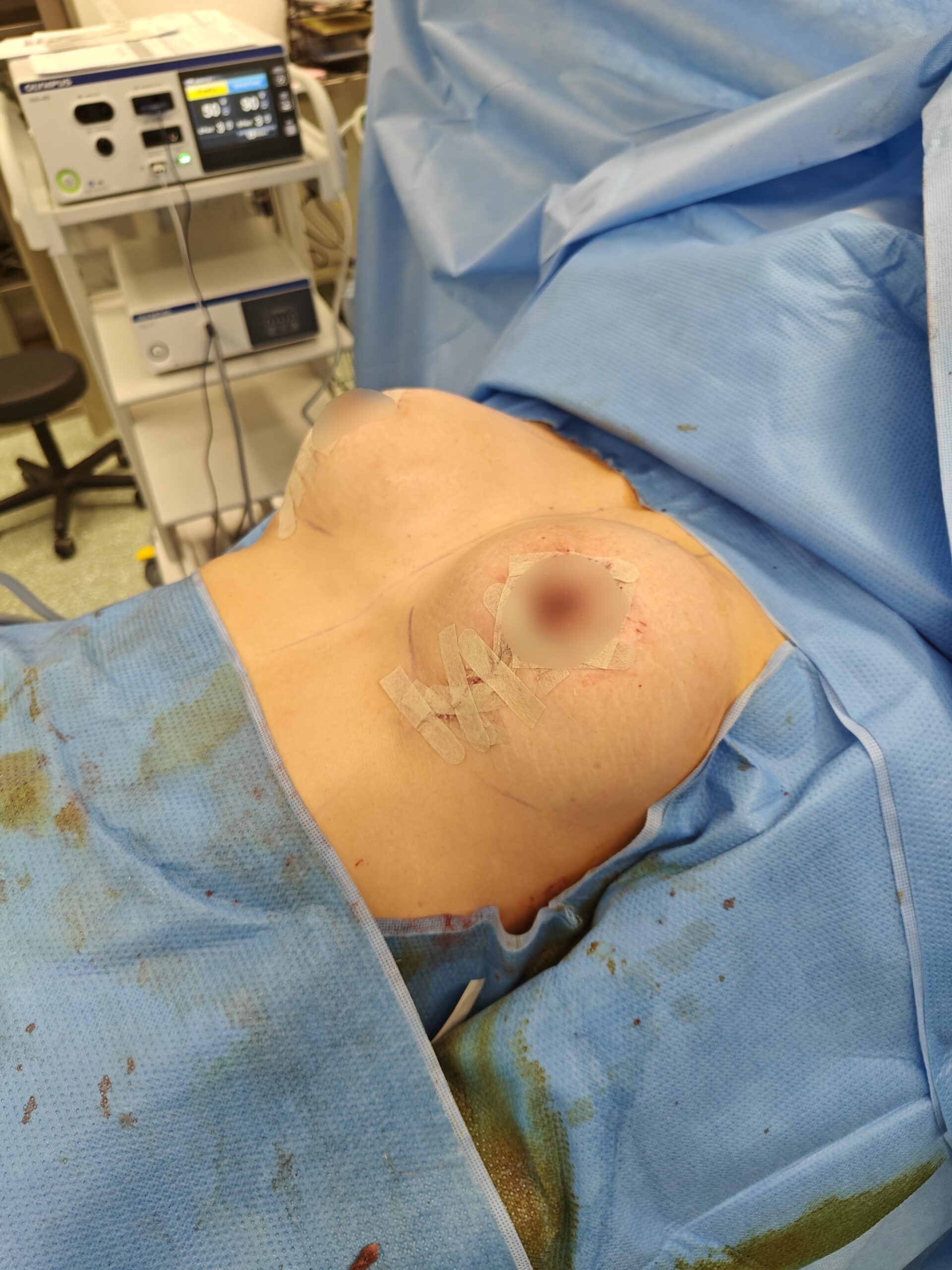 breast augmentation pexy
